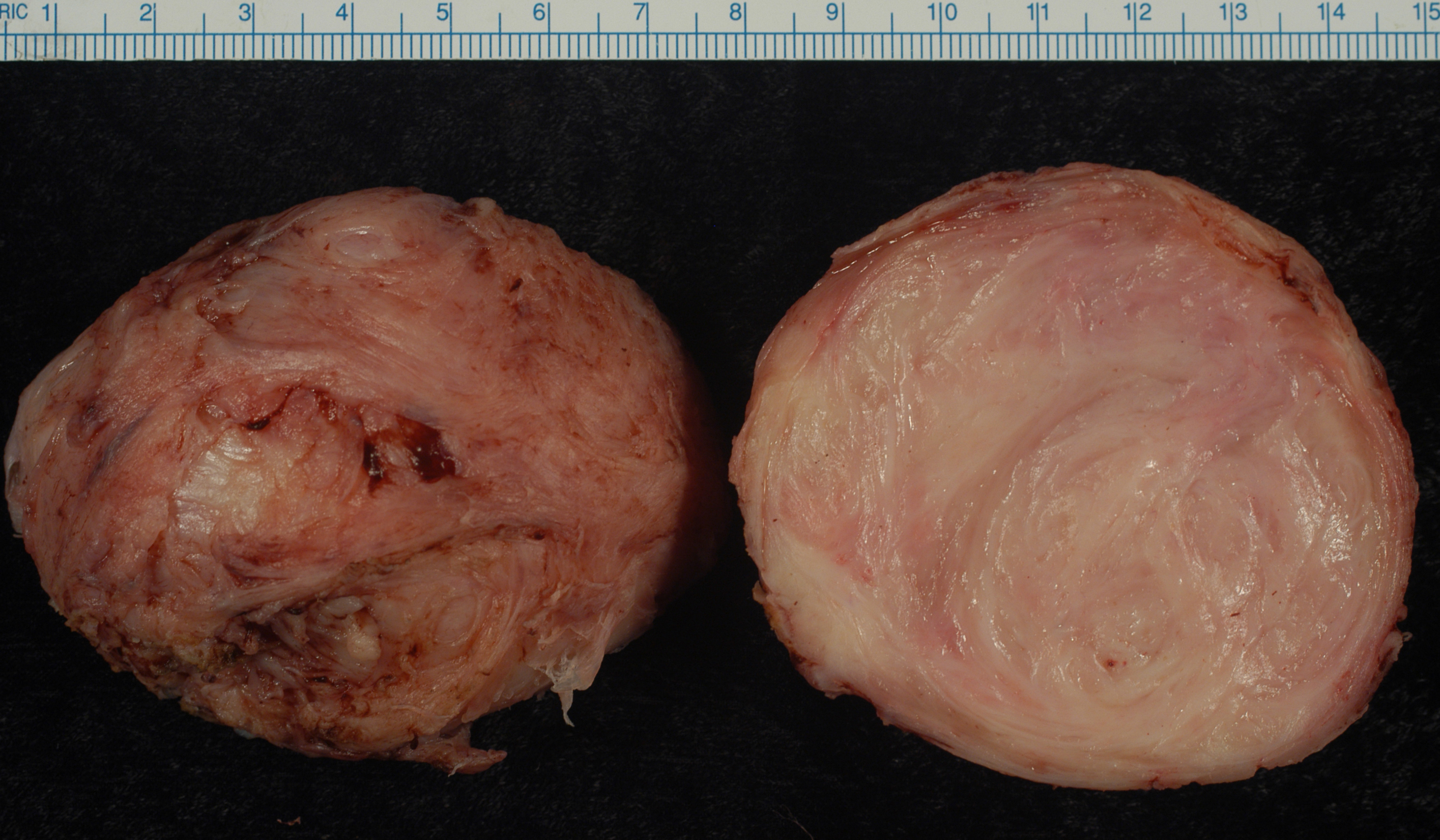 Leiomyom Uterus
Typische Schnittfläche mit einem scharf begrenzten grau-weiß-wirbeligen Knoten.